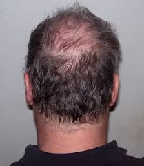 https://bengalanewstime.com/Hair Loss/
