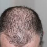 https://bengalanewstime.com/Hair Loss/