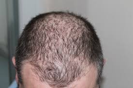 https://bengalanewstime.com/Hair Loss/